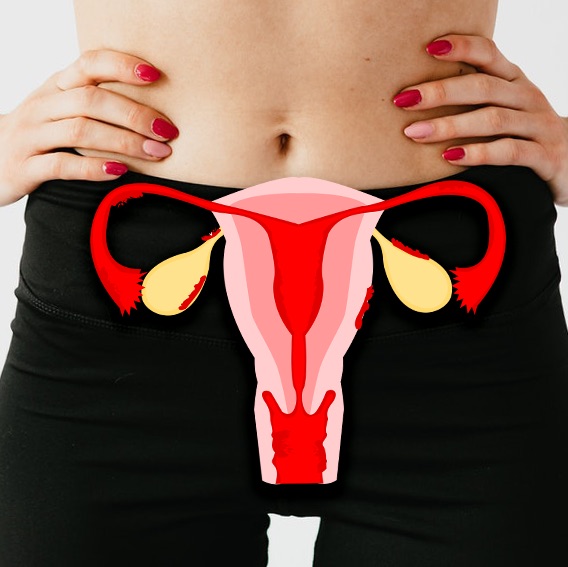 Endometriosis