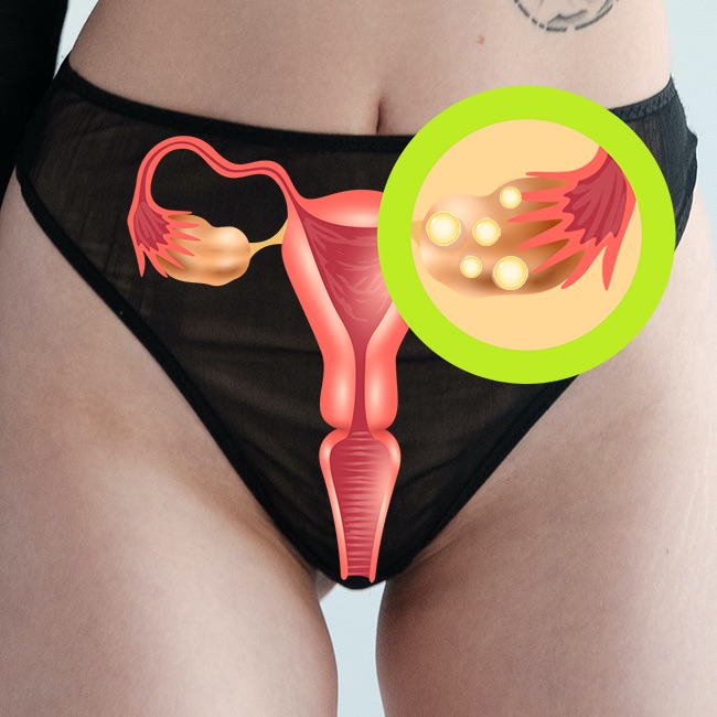Síndrome de ovario poliquístico (SOP)